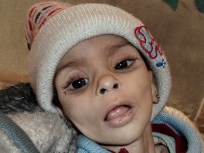 yarmouk_starvation_child